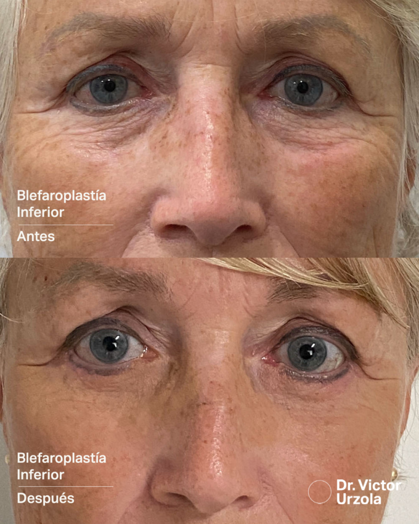 Face Procedures Blepharoplasty Dr. Victor Urzola